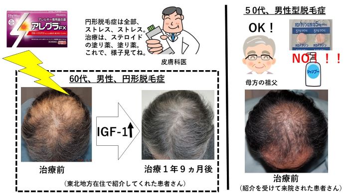 円形脱毛症　病院